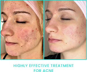 Peppermint Peel highly effective Acne treatment results