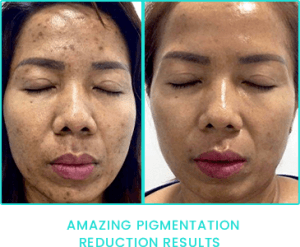 Peppermint Peel pigmentation reduction results