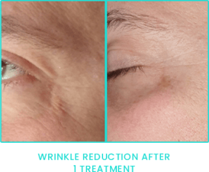 Peppermint Peel wrinkle reduction after one treatment